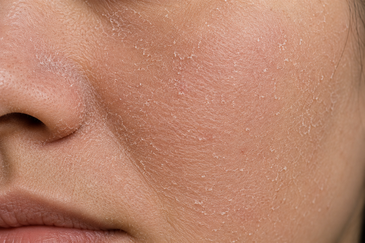 Dry Skin
